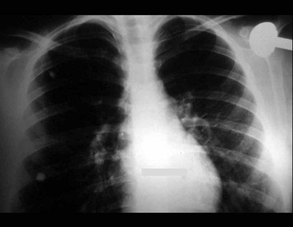 Figura 10: Radiografia do tórax com os dois nódulos pulmonares, após a prótese do úmero e antes da ressecção das metástases.