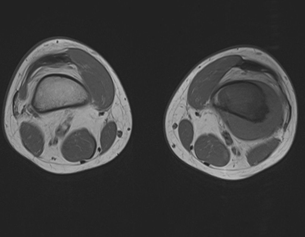 Figura 3: Rm axial T1 com tumor acometendo toda a região intramedular e as porções anterior, medial e posterior extracortical, desta região.