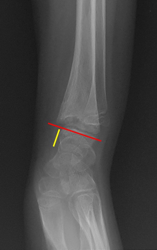 Figura 143: Radiografia em perfil, salientando o desvio volar e o desnível da placa fisária.