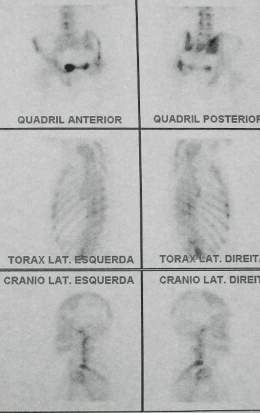 Figura 102: Cintilografia de quadril vista anterior e posterior, Tórax lateral esquerda e direita, Crânio lateral esquerda e direita