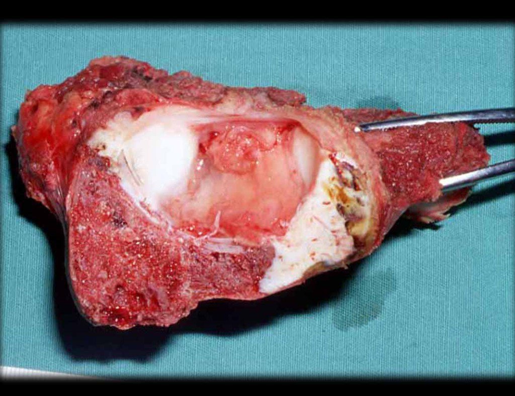 Figura 27: Vista do hemi cótilo ressecado, observa a porção da cartilagem em Y e a osteotomia do ramo anterior.