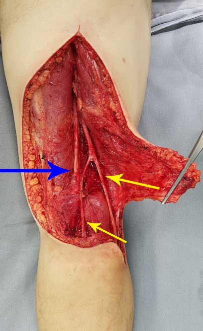 Figura 25: após retirada do tumor, reparem na hemostasia cirúrgica, a integridade dos tecidos e a anatomia dos nervos fibulares, representado pelas setas amarelas e do nervo tibial na seta azul.