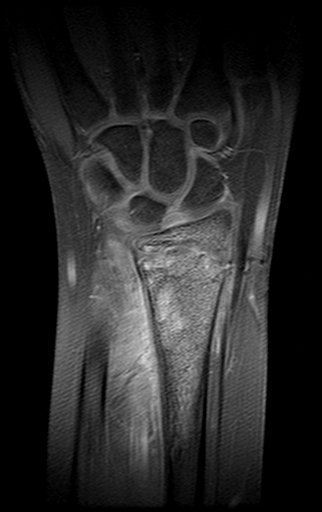 Figura 168: Rm coronal T1, Fat Sat.