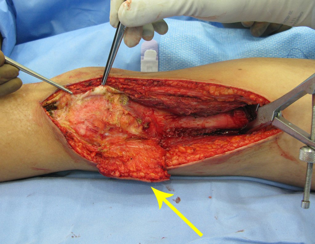 Figura 40: Descolamento da cápsula articular antero lateral, juntamente com o vasto lateral intacto. A seta amarela destaca o trajeto da biópsia sendo ressecado juntamente com a peça cirúrgia.