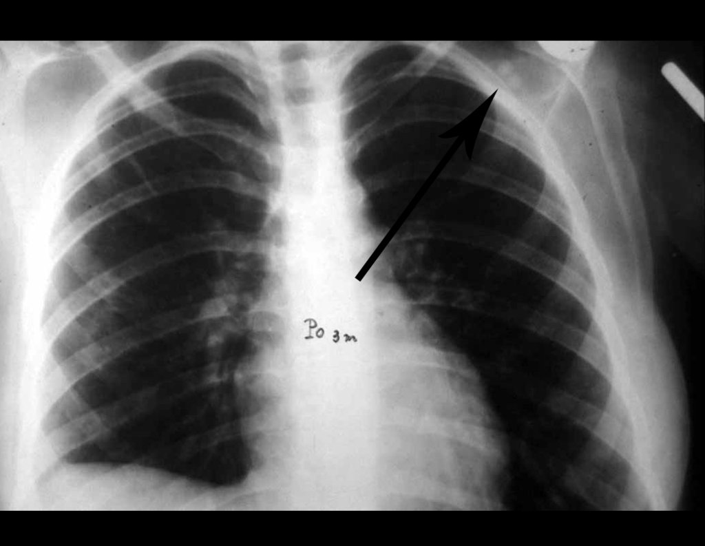 Figura 16: Radiografia do tórax, após o terceiro mês das cirurgias do tumor e da toracotomia, revelando o aparecimento de dois nódulos no ombro, evidenciando a recorrência local da neoplasia.