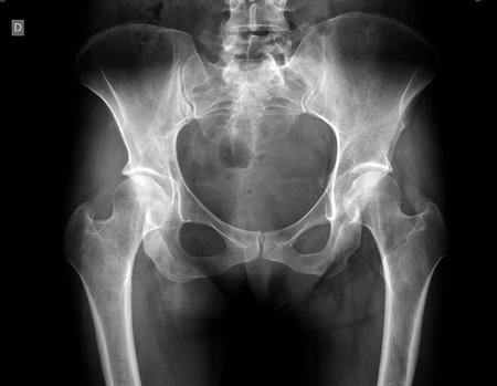 Figura 20: Radiografia de bacia frente, normal.