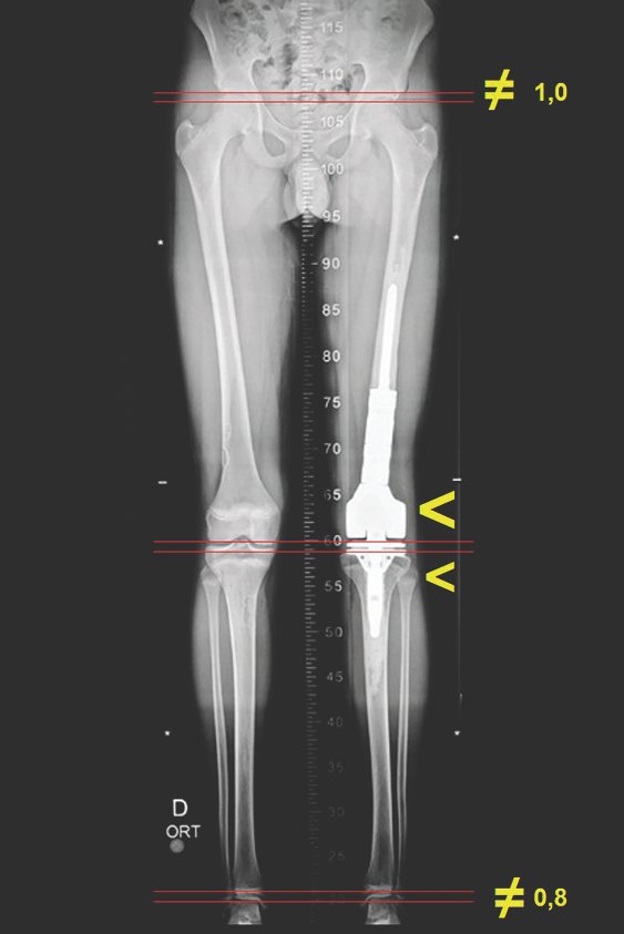 Figura 80: Escanometria revelando discrepância de 0,8 cm, às custas da tíbia e 1,0 cm às custas do fêmur, totalizando 1,8 cm de encurtamento.