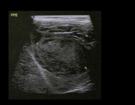 Figura 5: Ultrasonografia da coxa esquerda