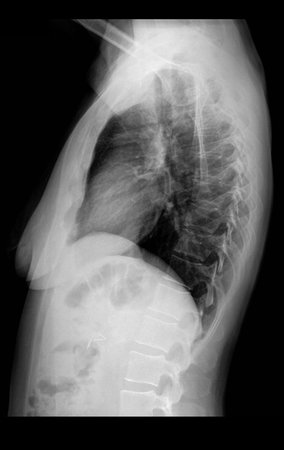 Figura 16: Radiografia de tórax perfil, normal.