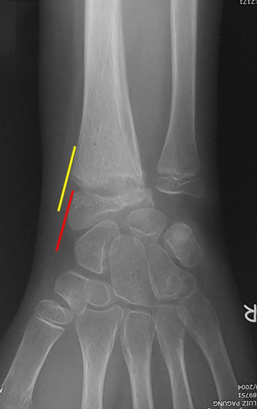 Figura 142: Radiografia do punho frente, em 23/01/206, com fratura descolamento epifisário (Salter Harris I). Observe o desalinhamento entre a cortical metafisária, linha amarela e a epífise, linha vermelha.