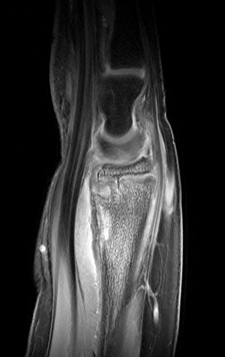 Figura 173: Rm sagital T1, pós Gad..