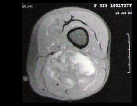 Figura 13: Rm ax T1 com saturação de gordura e contraste, lesão heterogênea, com áreas de baixo sinal, sinal intermediário e alto sinal, captação de contraste no interior da lesão, revelando neoplasia agresiva.