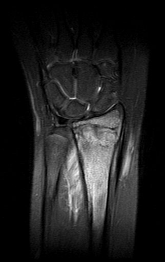 Figura 169: Rm coronal T2