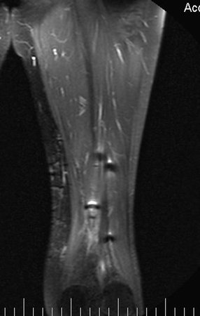 Figura 78: Rm coronal após um ano. As setas assinalam a presença dos clips metálicos marcadores do leito cirúrgico para a radioterapia.