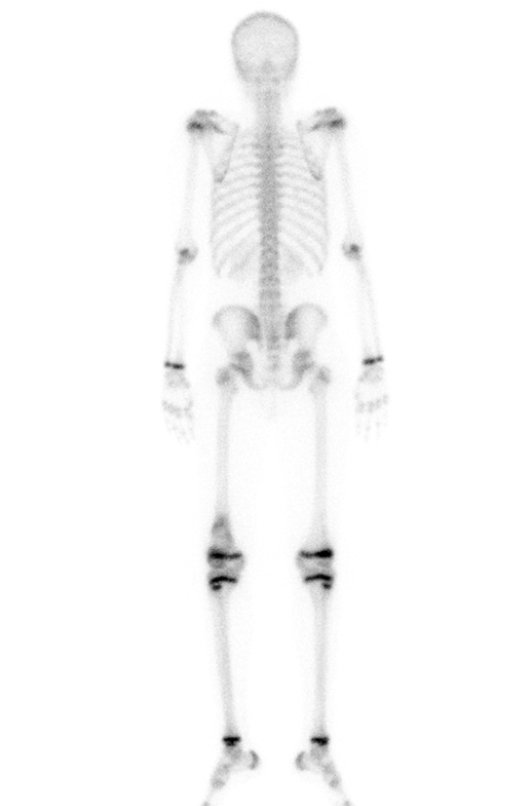 Figura 15: Cintilografia vista posterior, com captação alterada apenas na metáfise femoral esquerda. As lesões pseudo tumorais não captam. São cicatrizes, lesões latentes.