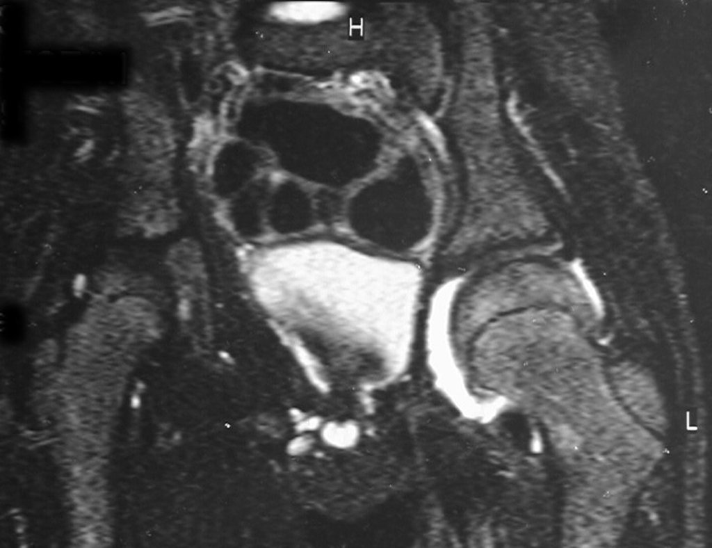 Figura 64: Rm cor Stir, quadril coberto, apoiado sob o teto acetabular remanescente.