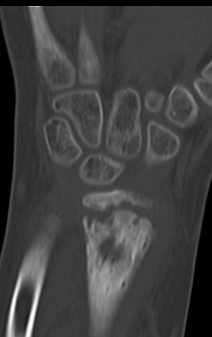 Figura 152: Tomografia de 31/Maio?2016, corte coronal.