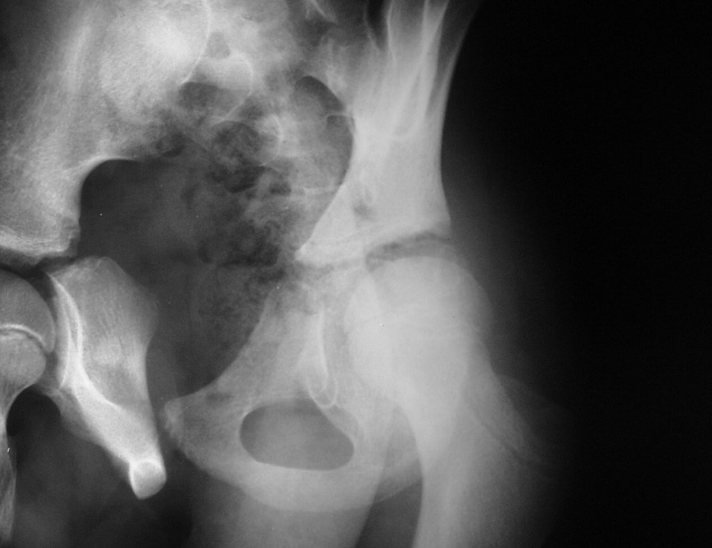 Figura 3: Radiografia de bacia obturatriz, onde se observa, com dificuldade o comprometimento de parte do teto e da tuberosidade isquiática. Pré Qt.