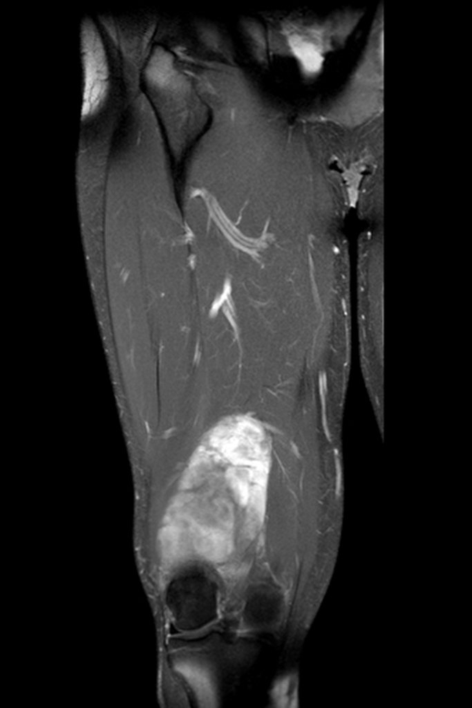 Figura 14: Corte coronal mostrando a agressividade da neoplasia.