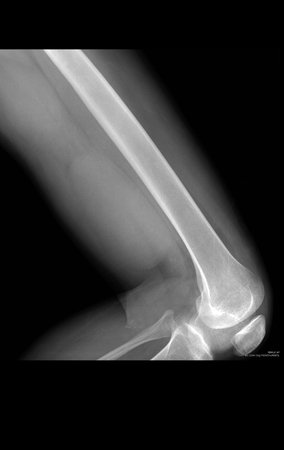 Figura 19: Radiografia do fêmur, perfil revela lesão de tecidos moles com aumento de densidade na face posterior e distal da coxa.