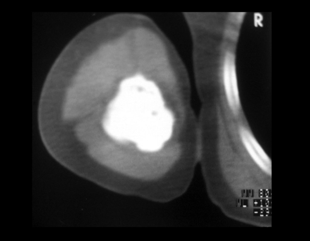 Figura 5: A cirurgia inadequada de curetagem propiciou a invasão deste tumor que inicialmente era apenas de superfície.