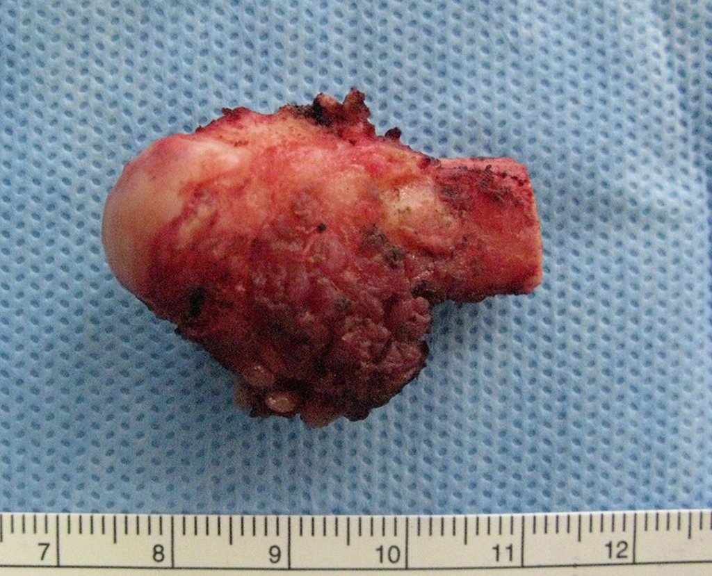 Figura 29: Peça ressecada, face plantar.