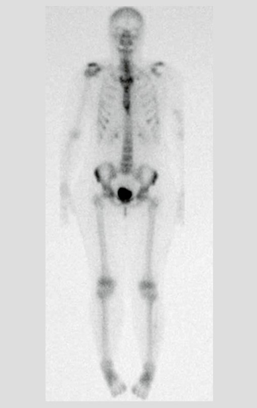 Figura 58: Cintilografia óssea, vista posterior.