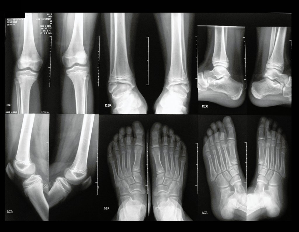 Figura 106: RX de joelhos,tornozelos, pés e tíbia em 03/10/2015