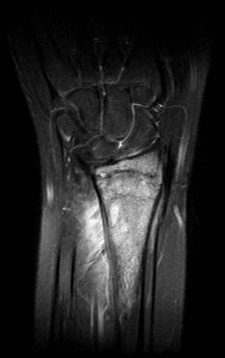 Figura 170: Rm coronal T2.