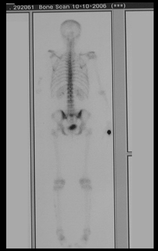 Figura 48: Cintilografia de 06/08/2014, após 27 anos de acompanhamento.