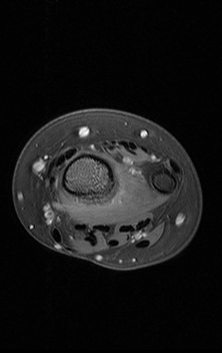 Figura 162: Rm axial T1, Fat Sat.