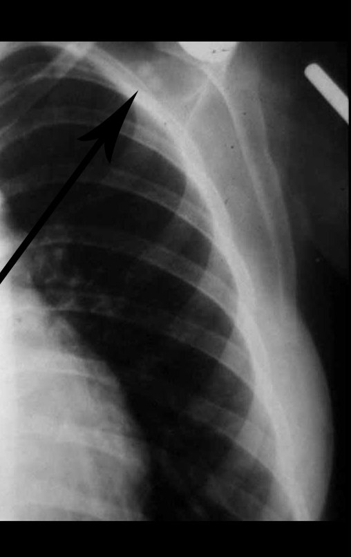 Figura 15: Radiografia após o terceiro mês da cirurgia. Aparecimento de dois nódulos próximos à cirurgia do ombro.