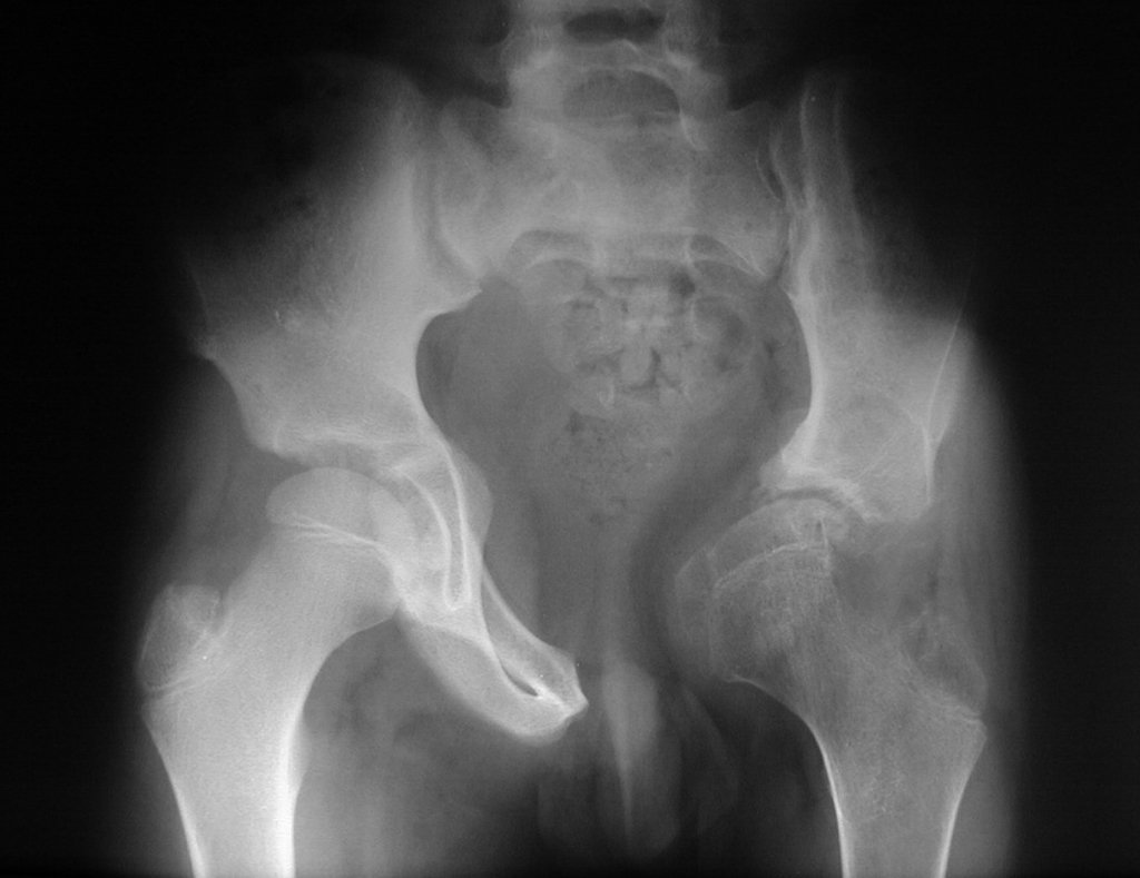 Figura 48: Radiografia de bacia frente, com "piora" da sub-luxação medial do quadril e deformidade acetabular, pelo aumento do tamanho da cabeça femoral, e hiperpressão.