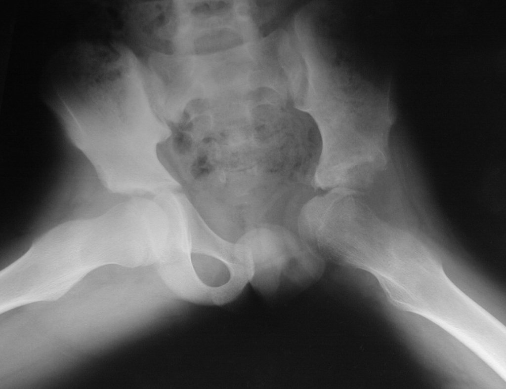 Figura 43: Radiografia de bacia Lowenstien, após dois anos e seis meses.