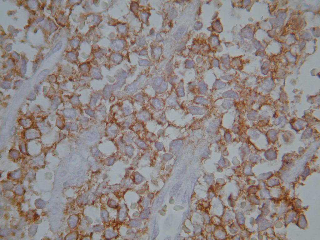 Figura 12: Imunohistoquímica com CD99 positivo, caracterizado pela coloração marron na membrana das células, fechando o diagnóstico de sarcoma de Ewing.