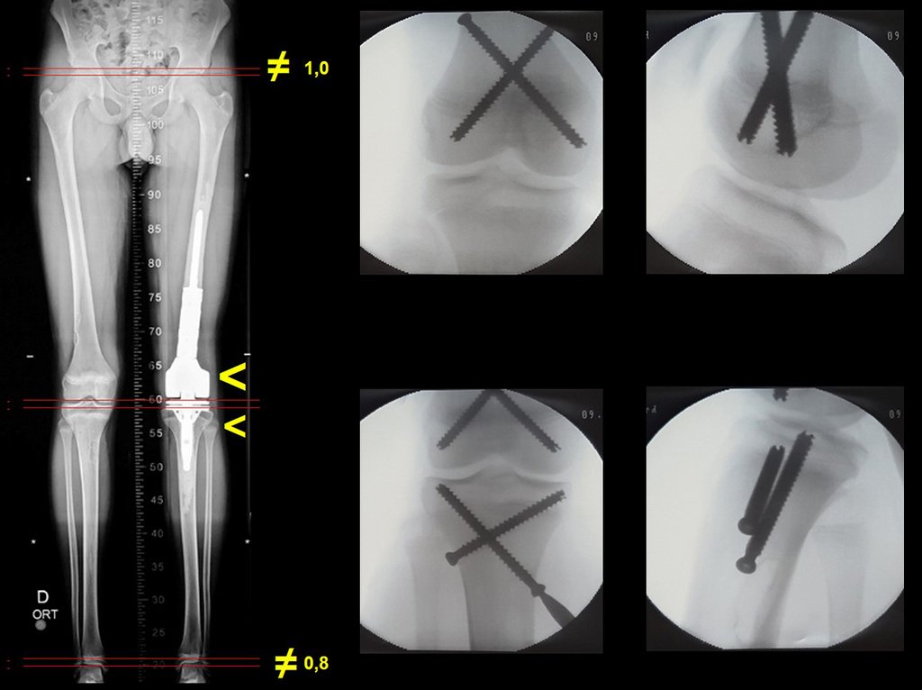 Figura 82: Escanograma com encurtamento, epifisiodese com parafusos canulados de rosca total, dois no fêmur e dois na tibia contralateral, visualização de frente e de perfil.