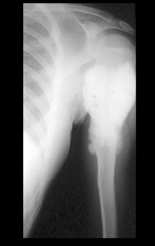 Figura 1: Radiografia do úmero esquerdo, frente, com lesão condensante, metadiafisária.