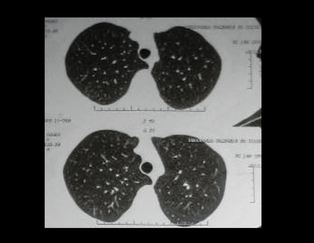 Figura 53: Campos pulmonares livres, 06/08/2014.