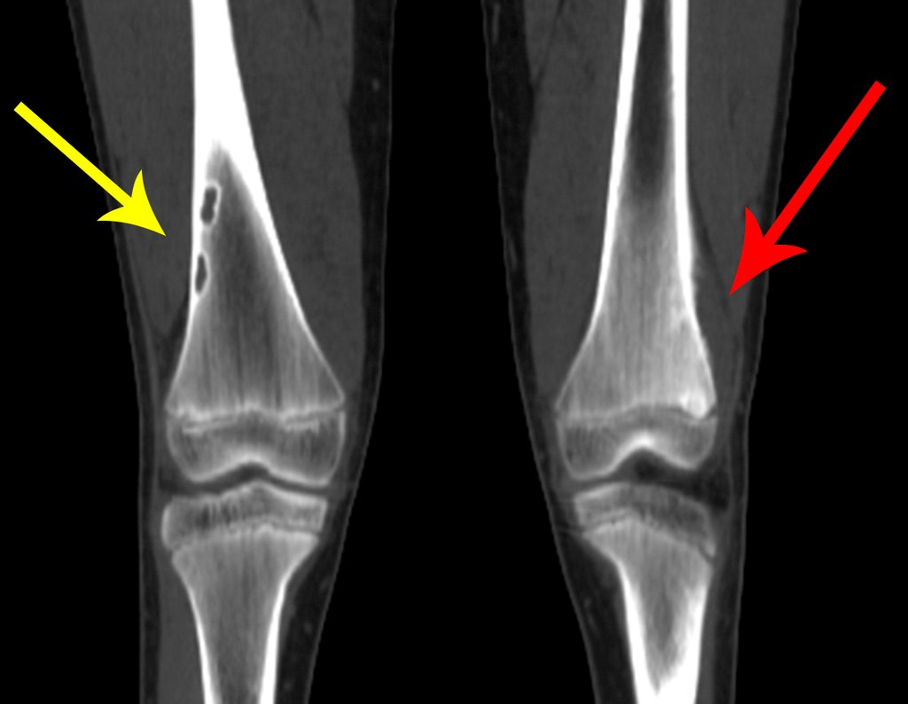 Figura 12: Tomografia coronal, duas lesões bem delimitadas , pseudo tumoral na cotical lateral do fêmur direito, seta amarela. Tumor na metáfise do fêmur esquerdo, seta vermelha.