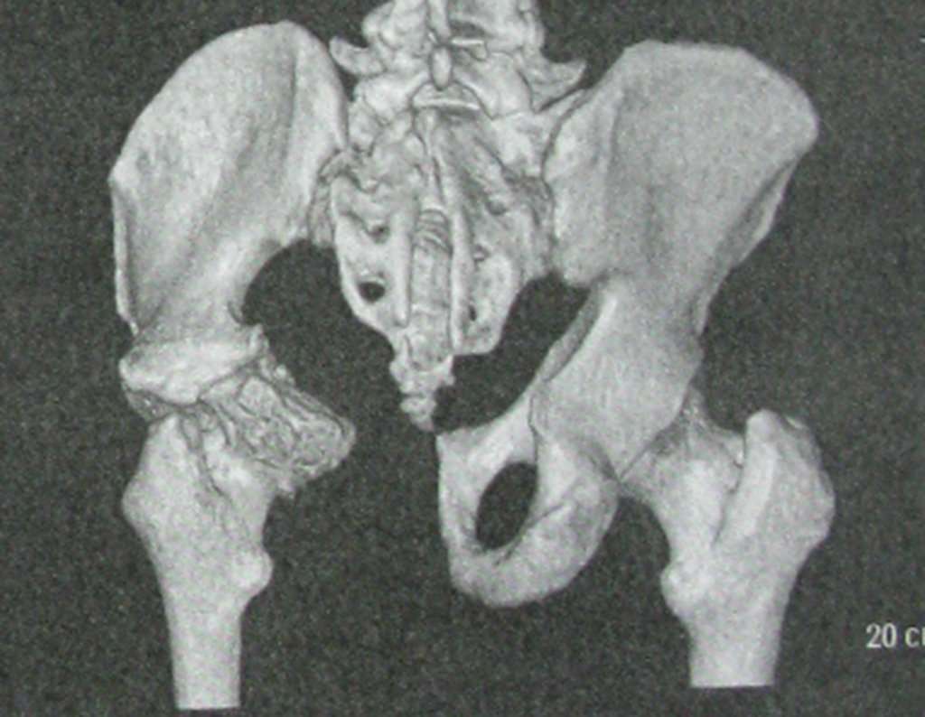 Figura 107: Tomografia computadorizada 3D vista posterior, evidenciando a ressecção do ísquio esquerdo.