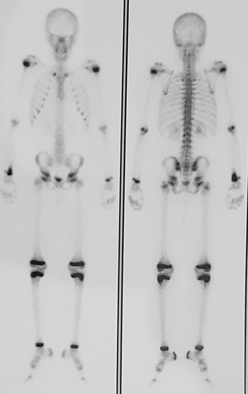 Figura 146: Cintilografia de 17/-05-2016, com hipercaptação no punho e antepé direito.