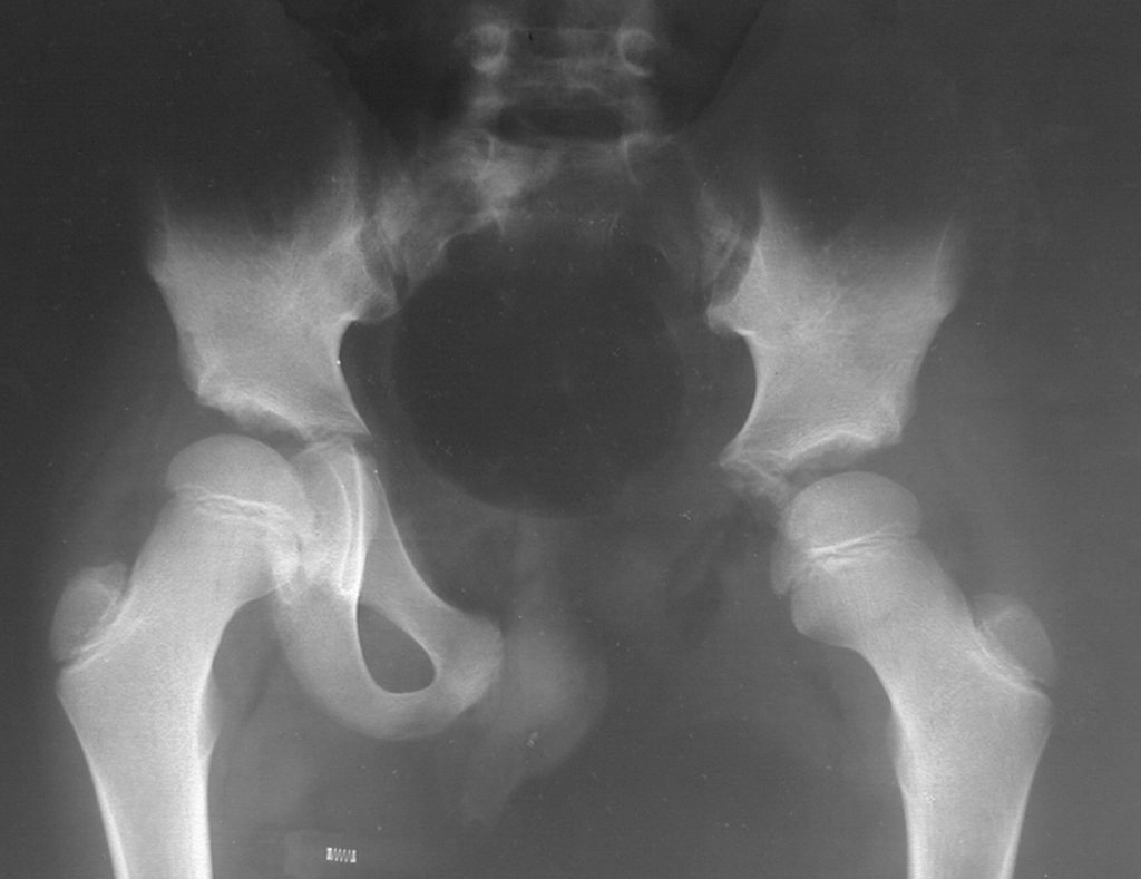 Figura 37: Radiografia de bacia frente, pós operatório de um ano.