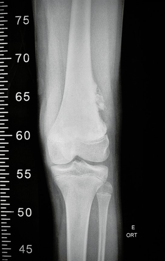 Figura 24: Radiografia do 1/3 distal do fêmur, incluindo o 1/3 proximal da tíbia, frente.