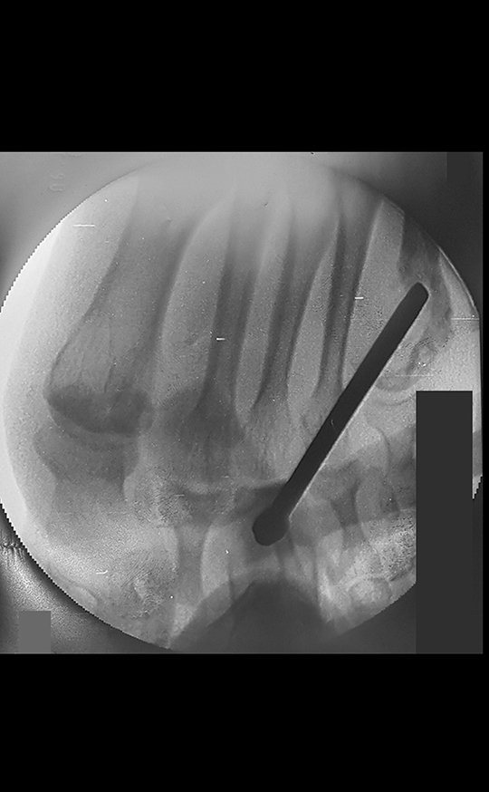 Figura 9: Biópsia da lesão, sob controle de radioscopia.