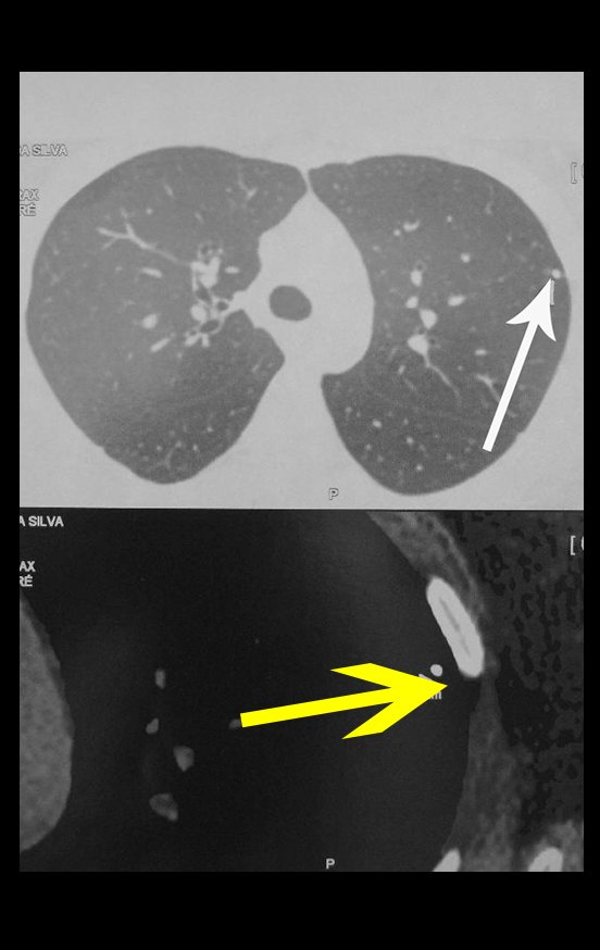 Figura 67: Controle pulmonar sem anormalidade. Em destaque o nódulo periférico calcificado, cicatriz da primo infecção da tuberculose.