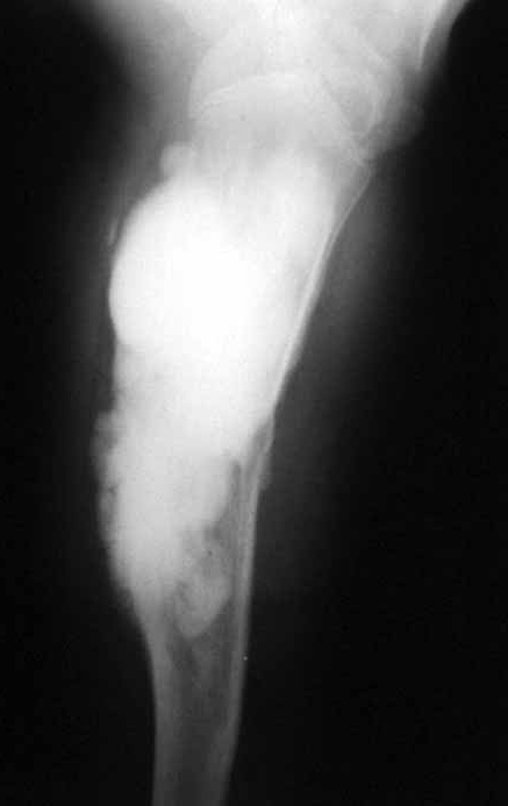 Figura 2: Radiografia do úmero esquerdo, perfil, com lesão invadindo o canal medular.