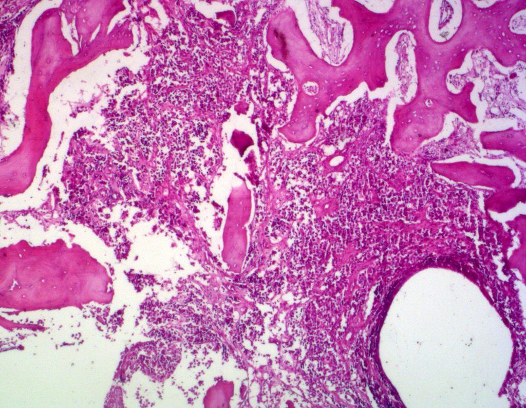 Figura 30: HE revelando neoplasia imatura de pequenas células.