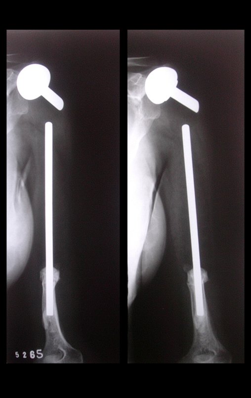 Figura 46: Radiografia da reconstrução do úmero com prótese de polietileno, após 19 anos.