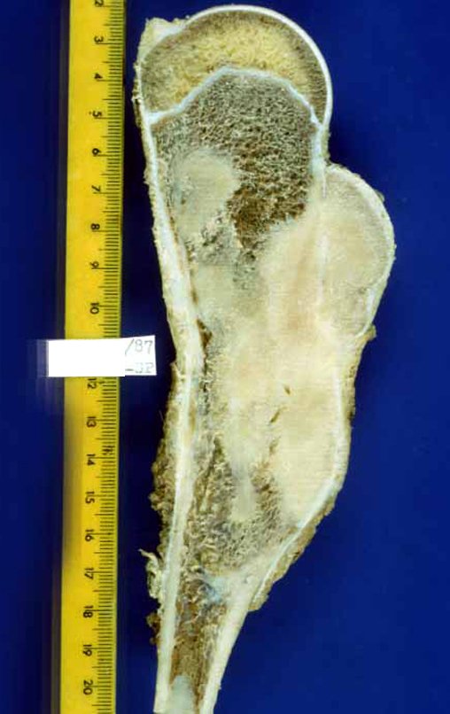 Figura 8: Corte da peça evidenciando a neoplasia de superfície e a infiltração medular ocorrida após as curetagens, inadvertidas.