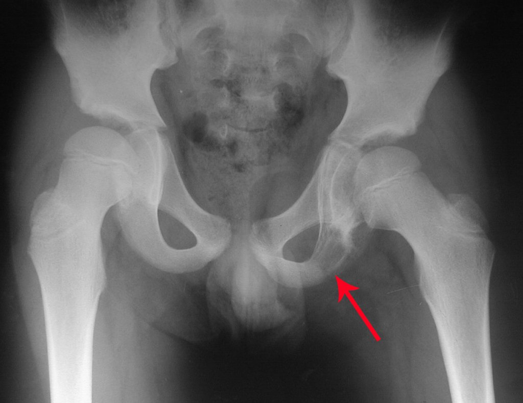 Figura 1: Radiografia de bacia frente, com lesão de rarefação óssea no ramo ísquio-púbico, pré-quimioterapia.